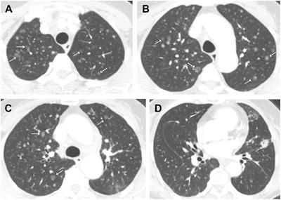 Case report: MSI-H, EGFR mutation, and ground-glass nodules as diffuse pulmonary hematogenous metastases